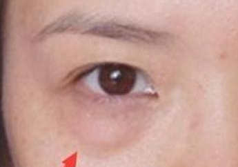 激光去眼袋的效果怎么樣？激光去眼袋注意事項有哪些？
