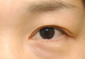 激光去眼袋術(shù)后會(huì)不會(huì)反彈？激光去眼袋術(shù)后注意事項(xiàng)？