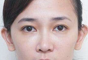 激光去眼袋后要休息多久呢？激光去眼袋會(huì)很痛嗎？