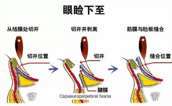 開外眼角和眼瞼下至的區(qū)別是什么?多久恢復(fù)好?