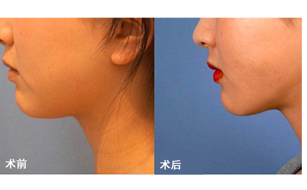 面部吸脂后皮膚會不會松弛？