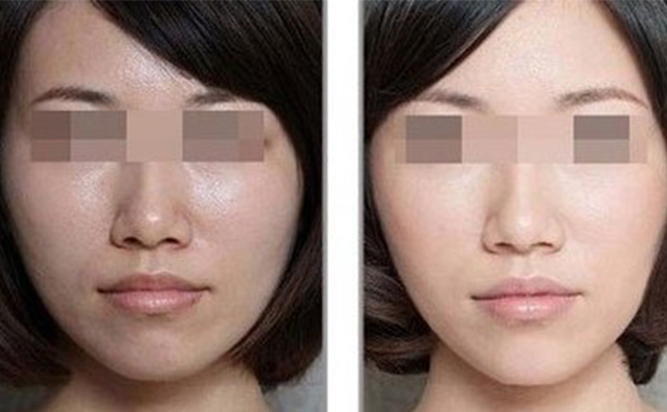 美白針的效果怎么樣？