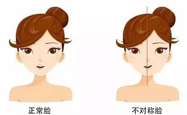 面部不對稱