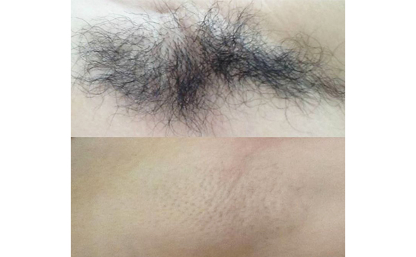 激光脫腋毛疼嗎？