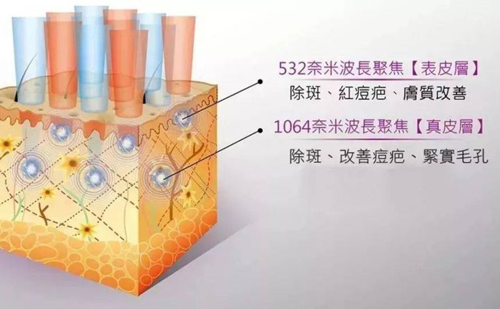 皮秒祛斑恢復(fù)期多久？