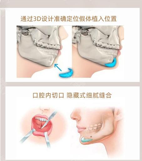 北京潤美玉之光醫(yī)療美容墊下巴示意圖