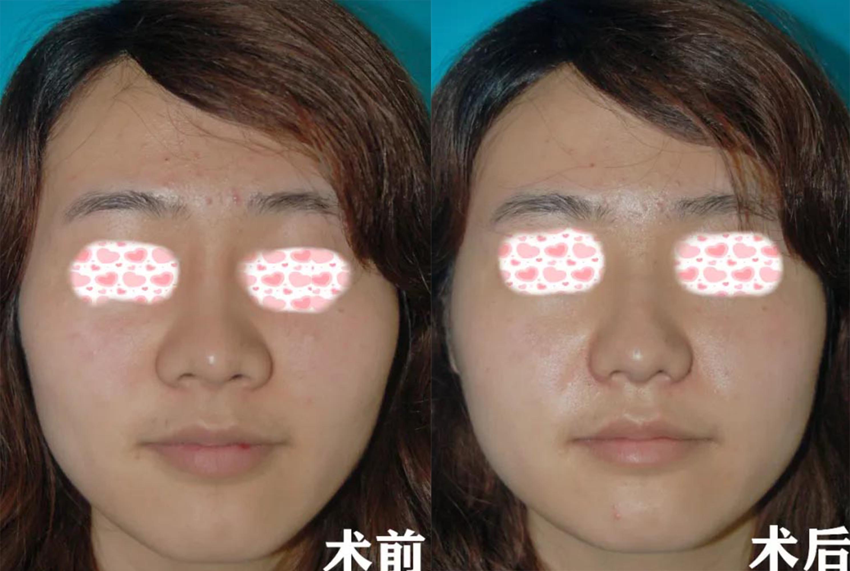 北京玉之光做鼻頭縮小術(shù)前術(shù)后效果對比