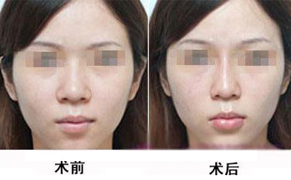 鼻頭縮小手術(shù)是怎么做的？術(shù)后應(yīng)該怎么護(hù)理
