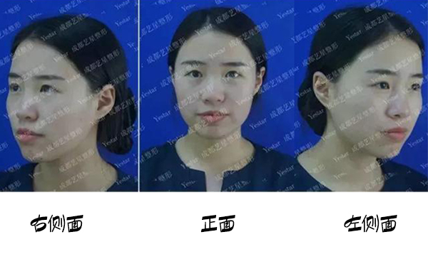 福州名韓整形改善蒜頭鼻大概要花多少錢？