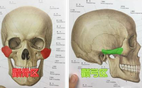 顴骨整形手術(shù)多久能消腫？