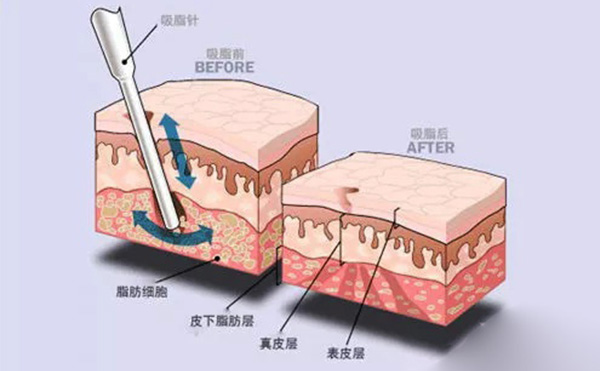 吸脂和溶脂有什么區(qū)別?哪個(gè)效果好?