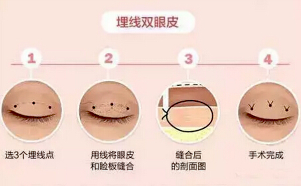 全切雙眼皮跟埋線的區(qū)別是什么？哪個好？