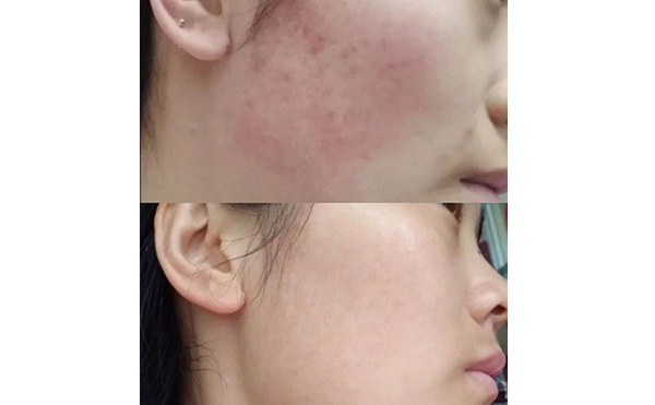 彩光嫩膚會讓皮膚變薄嗎？