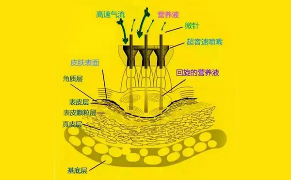 無針?biāo)忉樖窃趺醋龅?效果怎么樣?