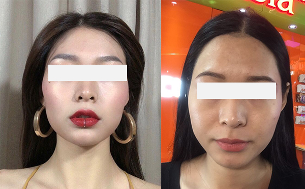 激光脫發(fā)際線效果怎么樣？