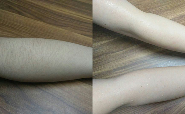 冰點(diǎn)手臂脫毛會(huì)傷害皮膚嗎？