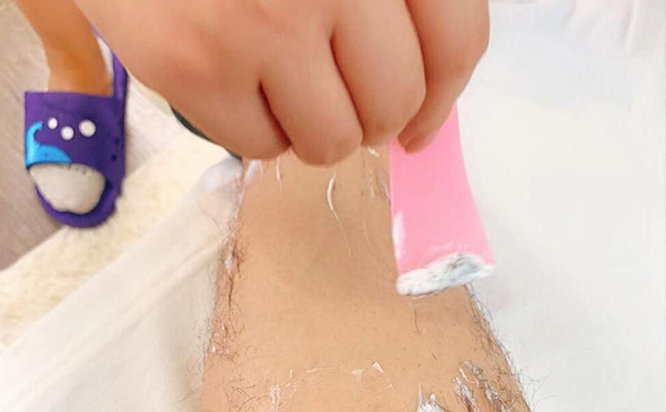 激光脫毛