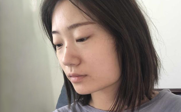 下頜角整形適宜人群有哪些？