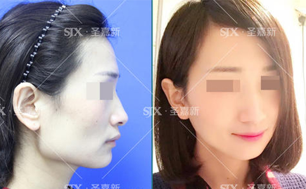 下頜角整形后皮膚是否會(huì)松弛？