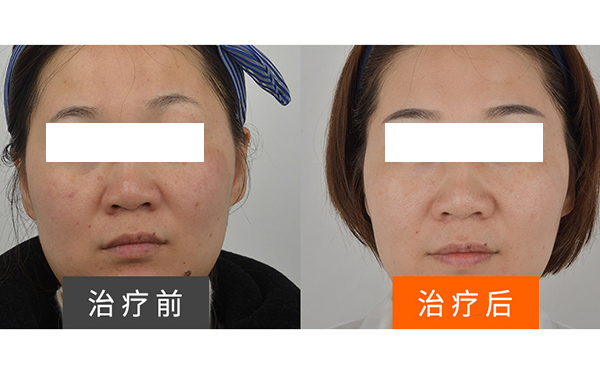 彩光嫩膚安全不安全？