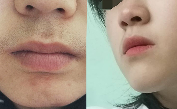激光脫毛的效果怎么樣？