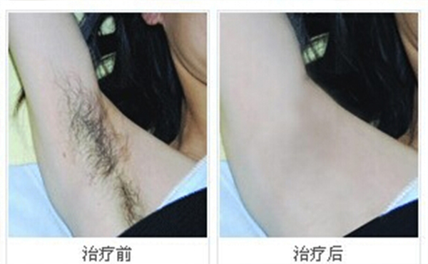 冰點脫腋毛安全嗎？