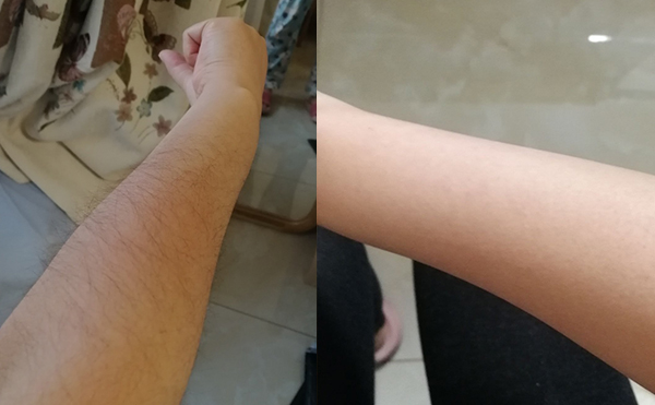 光子手臂脫毛幾次能脫完？