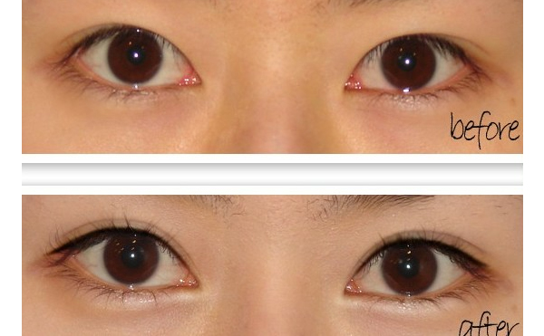 開眼角手術(shù)有什么原則？