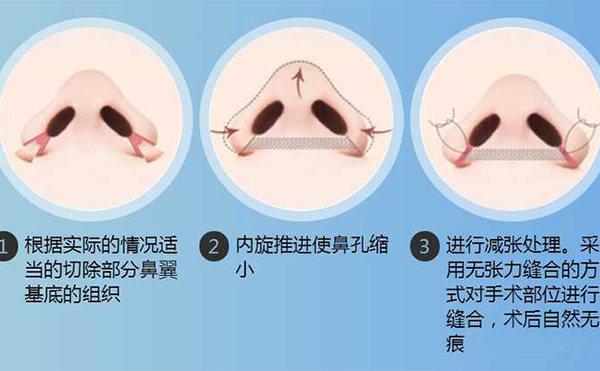 鼻翼縮小手術(shù)有用嗎？