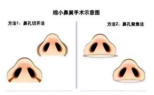  鼻翼縮小有后遺癥嗎？會不會反彈