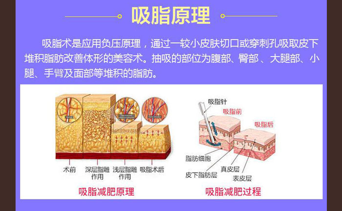 水動力吸脂效果好嗎？
