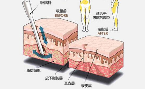大腿吸脂有什么優(yōu)點？