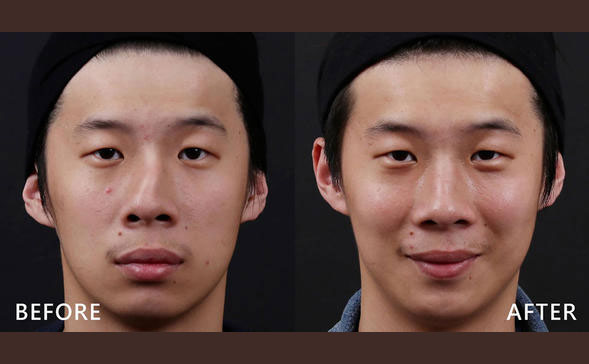 鼻骨矯正手術(shù)多少錢？鼻骨矯正手術(shù)危險嗎？