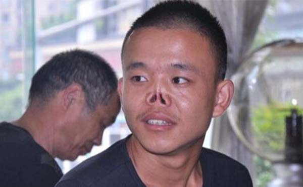鼻再造手術(shù)有什么風險?