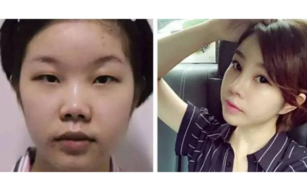 鼻頭縮小手術(shù)是怎么做的?效果怎么樣?