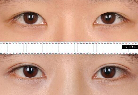 做雙眼皮價格是多少？哪種眼睛適合做雙眼皮呢?