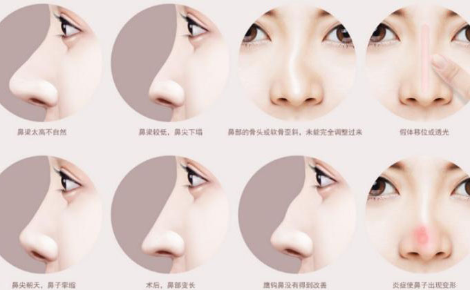 鼻尖整形大概多少錢？