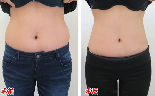腹部吸脂效果如何？