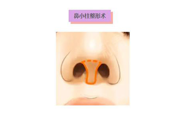 鼻小柱延長術(shù)是什么？鼻小柱延長手術(shù)有什么優(yōu)點