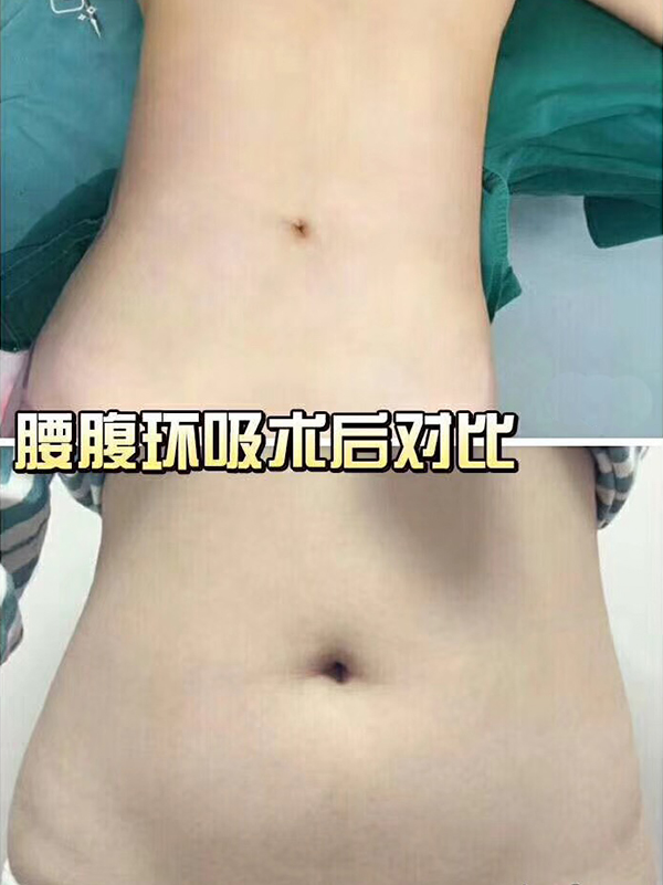 腰腹環(huán)吸術(shù)效果對比圖1