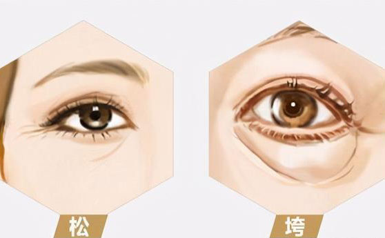 無(wú)痛去眼袋價(jià)格多少錢？