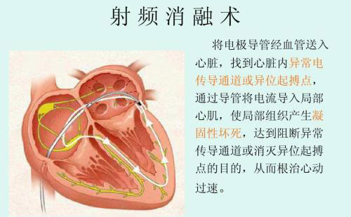 射頻祛眼袋效果怎么樣？