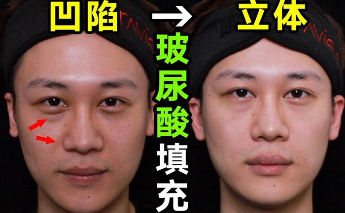 淚溝填充用什么方法最好？淚溝填充手術(shù)大約多少錢？