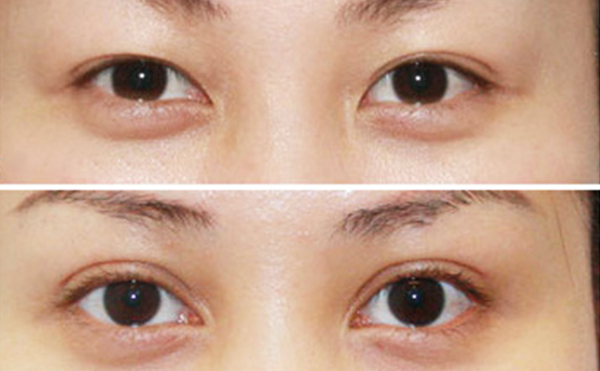 內(nèi)雙做雙眼皮是什么價格？效果怎么樣？