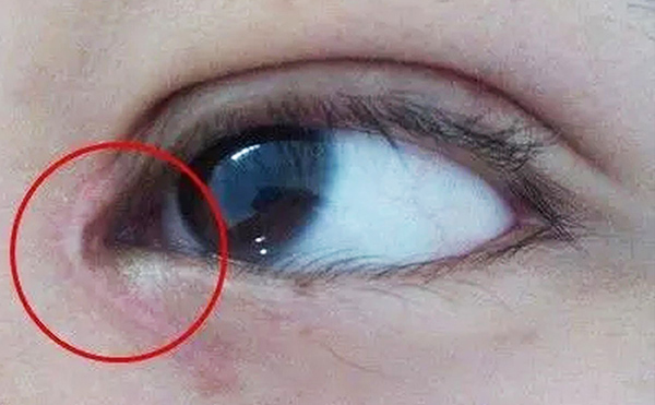 內(nèi)眼角修復(fù)難不難？哪些情況需要修復(fù)?