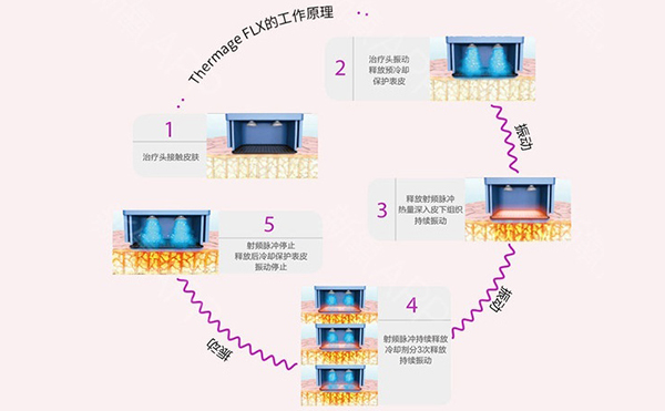 電波拉皮怎么去除魚尾紋？