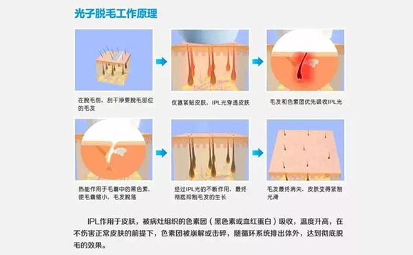 脫毛方法有哪些?都有什么區(qū)別?