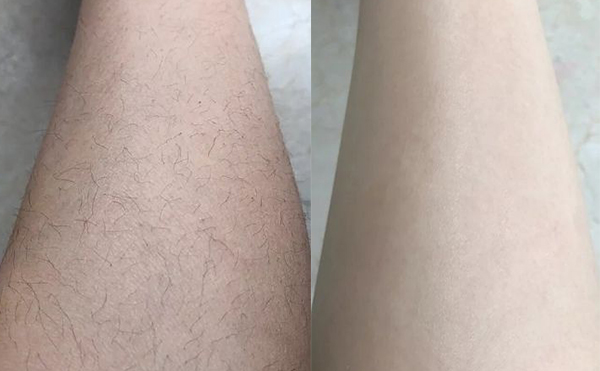 冰點(diǎn)脫腿毛效果怎么樣？