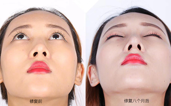 隆鼻手術(shù)失敗怎么辦？修復(fù)費用要多少？