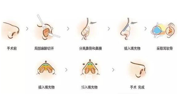 耳軟骨隆鼻效果怎么樣？要多少錢？